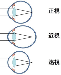 遠視や近視が薬で治る日は近い？