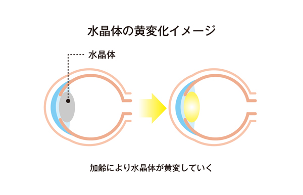 水晶体の黄変化イメージ